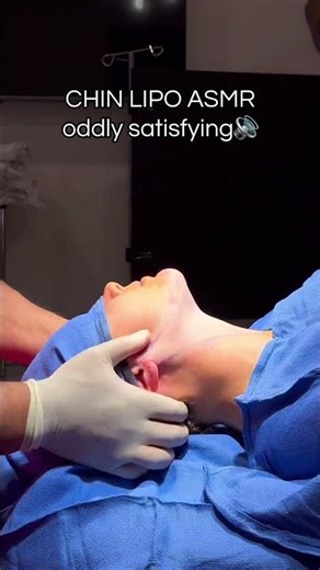 Satisfying Chin Lipo Results 🤩