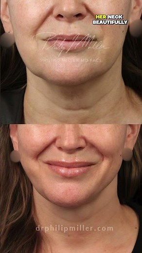 50-Year-Old Elena’s Stunning MicroLift & Platysmaplasty Transformation | Natural, Lifted, Confident