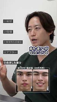 Under-Eye Dark Circle Removal ▶ Male in his 20s (Treatment for deep-set eyes)