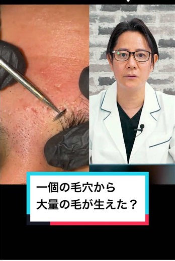 @Mahmoud Gamal @Mahmoud Gamal なぜひとつの毛穴からこんなに毛が生えるのですか？現役皮膚科医が解説 #duet ※この動画はTikTokのデュエット機能を活用しデュエット可の動画のみ使用しています。 #毛穴 #毛穴ケア #毛