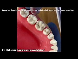 Class I, buccal pit & class II (MOD) cavity preparations. Lower 6