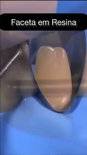 RESTAURAÇÃO EM RESINA COMPLETA#shortsvideo #shortsfeed #odonto #odontovideos #resumosdeodonto#dental