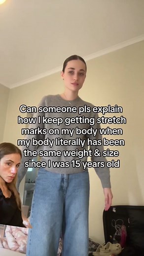 Stretch marks appear when the skin is rapidly sterched, such as with s... | stretch marks