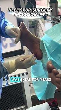 Heel Spur Surgery – Part 1