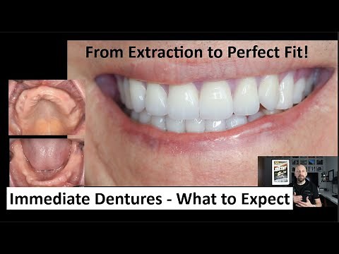 From Extraction to Perfect Fit - the Immediate Denture Journey