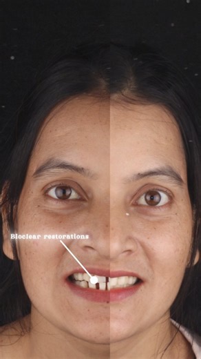 Those gaps didn’t disappear by accident. They were closed with Bioclear, gently, intentionally, respectfully. Her teeth were already straight. Her treatment was technically ‘done.’ But every smile still carried a pause... a hesitation only she noticed. She wasn’t asking for a dramatic change. She just wanted her smile to feel whole, without drilling, without harming healthy enamel. With Bioclear restorations, the gaps were closed while preserving what was already beautiful. Because sometimes, fi