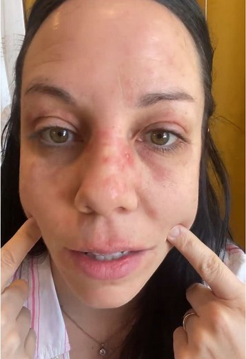 #sephora #youthtothepeople #desastres #skinburn