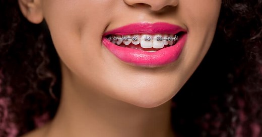 Dental Insurance for Braces: The Best Orthodontic Coverage - Dentaly.org