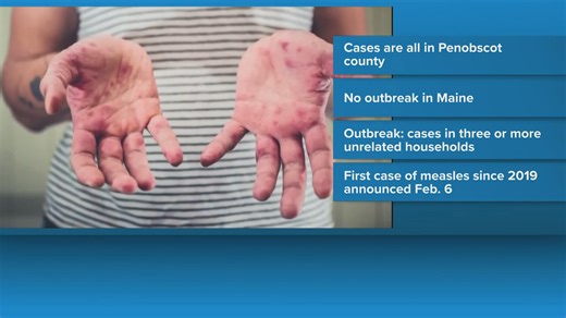 Four more measles cases reported in Penobscot County, now totaling five