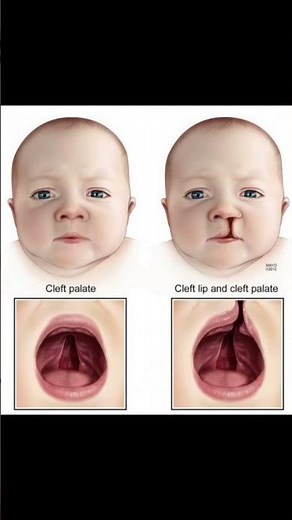 Left-sided cleft lip and palate (complete cleft involving lip, alveolus, and palate)