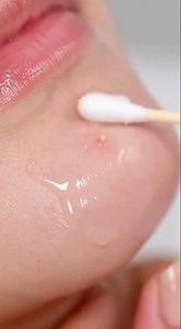 Whitehead Removal on Chin (Gentle Cosmetic Extraction)