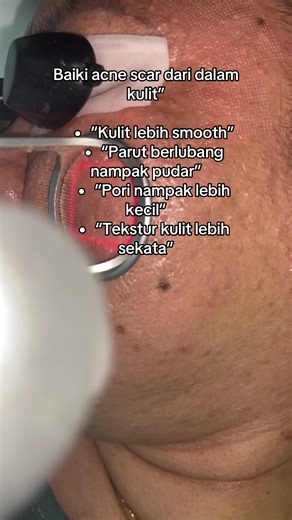 Acne scar masih jelas walaupun jerawat dah hilang? 😣 📍 Beauty Skin Centre, Larkin 📲 WhatsApp: 018-7810112 #acnescar #parutjerawat #co2laser #subcision #rejuran
