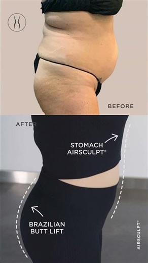 Jen Linton Stomach AirSculpt and Power BBL Fat Transfer