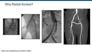 Thirteen Steps to Avoid Radial Artery Access Complications in Peripheral Arterial Interventions