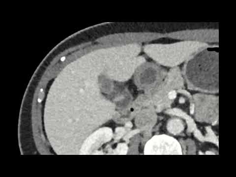 Focal Adenomyomatosis of the Gallbladder: Hourglass Configuration on CT and MRI