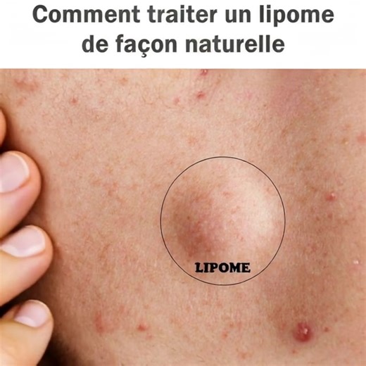 Comment traiter un lipome de façon naturelle (lien en commentaire) | Les astuces pour débutants