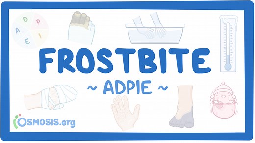 Frostbite: Nursing process (ADPIE): Video, Causes, & Meaning | Osmosis
