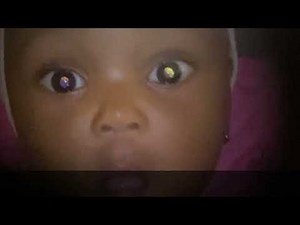 Fundal ‘Red’ Reflex Examination Findings for Primary Eye Care (English): Arclight Project