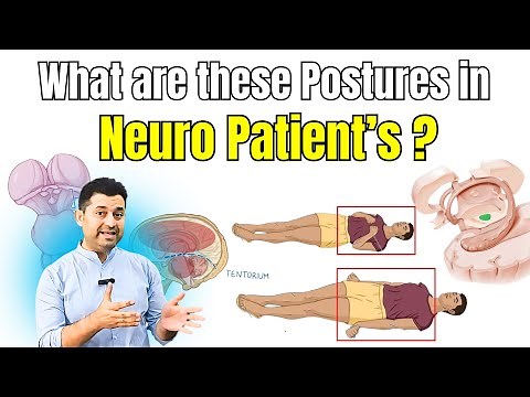 Understand Decorticate & Decerebrate Postures in 2 Minutes.