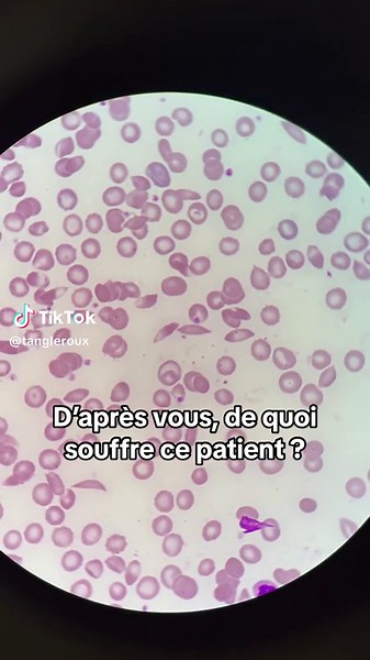 Diagnostic médical : analyse de sang et identification des cellules