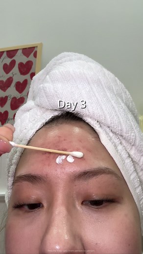 Effective Acne Treatment with Dr. Leo's Drying Lotion