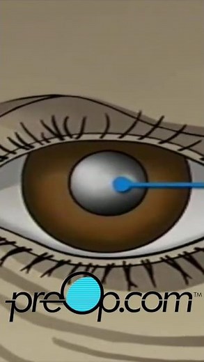 PreOp® Cataract Small Incision: Insight That Empowers Care | Patient Education #shorts