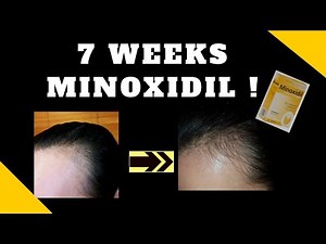 7 Weeks of using Minoxidil on Female Hairline BEFORE and AFTER