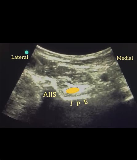 PENG block | Wiquar Ahmed