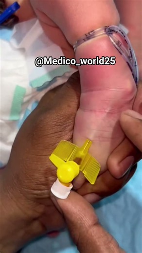 Iv cannula insertion in hand #medicoworld #clinicalskills #nurse #medicaleducation #medicalstudent