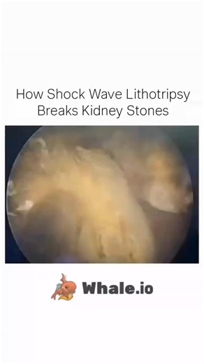Science Nexa on Instagram: "Shock Wave Lithotripsy (SWL) is a non-surgical medical procedure used to break kidney stones into tiny fragments using high-energy sound waves. These smaller pieces can then pass naturally through the urinary tract, reducing pain and recovery time. Modern medical science making treatment safer and easier! . . . #medicalanimation #humanbody #trending #sciencefacts #scienceexploring"