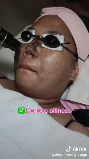Discover the Benefits of Black Doll Carbon Laser Treatment