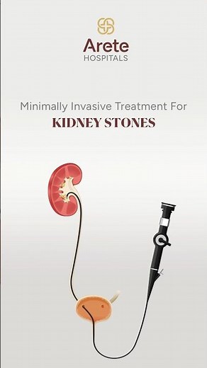 Minimally Invasive Treatment For KIDNEY STONES | Dr Khizar Raoof | Arete Hospitals