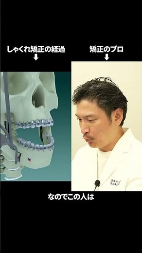 しゃくれってどうやって治す？#歯列矯正#外科矯正#しゃくれ