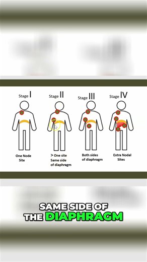 Lung Cancer Stages Explained: A Comprehensive Guide #shorts
