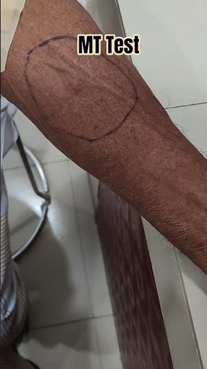 Mantoux Test (MT- for tuberculosis (TB) screening