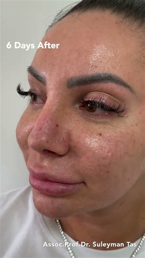 Rhinoplasty Before and After: Life Is Full of Wonderful Surprises | Prof. Dr. Suleyman Tas