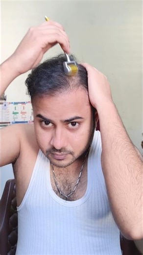 Derma Roller | Micro needling process | Hair Regrowth