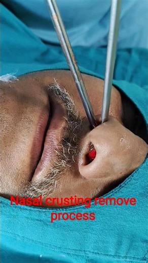 Nasal crusting remove #viralvideos #gkmp #shortsvideo