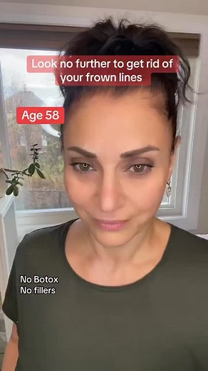 Frown lines (the “11s” between your brows) form when the corrugator and procerus muscles are overworked from repeated contractions — often due to stress, tension, or habitual facial expressions. Over time, these muscles stay semi-contracted, creating creases in the skin above them. Massaging with the FaceFit Roller helps relax and get rid of the lines. #facefitcanada #facefitroller #naturalfacelift #facerolling #womenover50 #over50 #naturalbotox #beautytool #lymphaticdrainage #faceroller #health