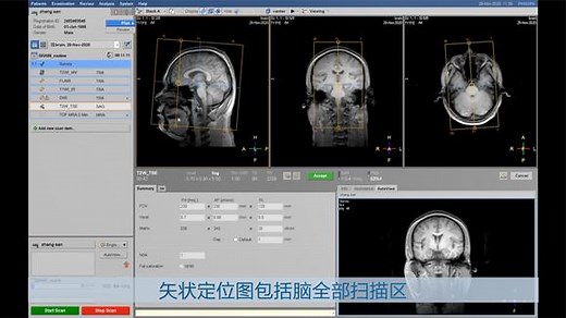 [飞利浦MRI]头部磁共振扫描技术之完整版