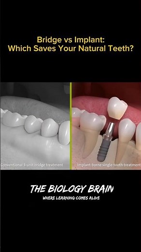Dental Implant vs Bridge. Which Is Better? | 3D Animation #dentalimplants #oralhealth #shorts