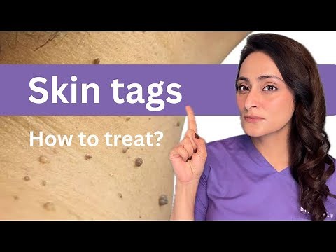 Why do skin tags form? How to treat ? Dermatologist suggests