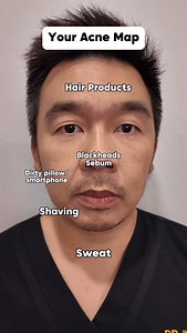 Acne Struggle? 🤔 Your Acne Map: Decode Where Your Breakouts Are Striking! Is it a forehead full of stress breakouts? A nose plagued by blackheads? Or maybe a jawline ravaged by shaving? Let’s map out our acne together! Comment below with your biggest acne struggle: * Hairline Havoc: (From hair products) * Nose-y Blackheads: (Sebum overload) * Shaving Shenanigans: (Jawline irritation) * Pillowcase Peril: (Dirty pillow woes) * Cheek Cheek Chaos: (Other cheek concerns) #AcneMap #Skincare #Skincare