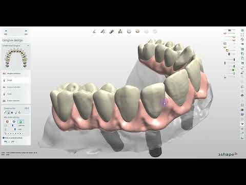 How to Design a Digital All on X Implants Bridge with the Thimble Crowns in 3Shape
