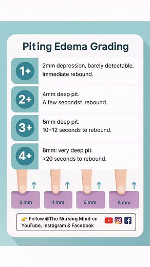Pitting Edema Grading Understanding pitting edema is essential for accurate patient assessment and better care. From 1 (mild) to 4 (severe), this simple clinical tool helps nurses and doctors evaluate fluid retention and monitor treatment. 👉 A must-know for every nursing student, staff nurse, and healthcare professional. ⸻ #Nursing #NurseLife #MedicalNotes #NursingStudents #NurseEducation #PittingEdema #ClinicalSkills #NursingAssessment #HealthcareProfessionals #NursingCare #NursesOfIndia #Nurs