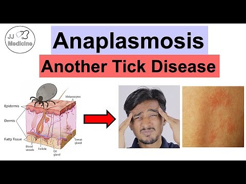 Anaplasmosis: A Tick Infection You Might Not Know You Have (Symptoms, Diagnosis, Treatment)