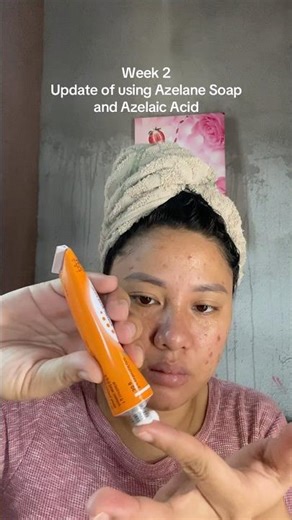 Week 2 of using Azelane Soap & Skinoren | March 30