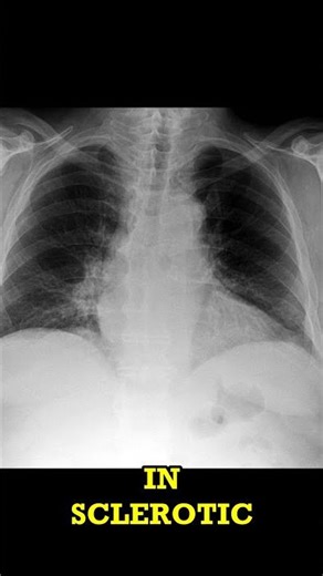Chronic Bronchitis on Chest X-Ray: Radiology Short