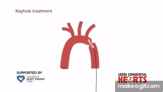 Coarctation of the Aorta: treatment on Make a GIF