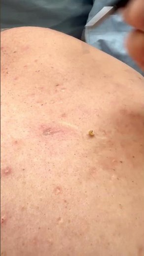 Black Head on Back